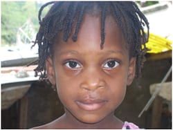 A four-year-old girl from Haiti, after surgery