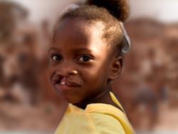 A four-year-old girl from Haiti, before surgery