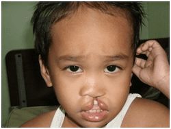 A two-year-old boy from the Philippines, before surgery