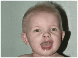 A one-year-old boy from Ukraine, after surgery