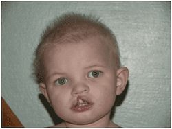 A one-year-old boy from Ukraine, before surgery